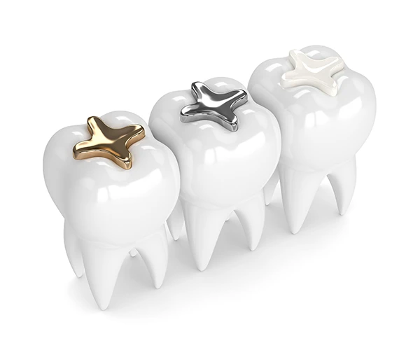 Three teeth each with a different dental filling material: composite, amalgam, and gold.