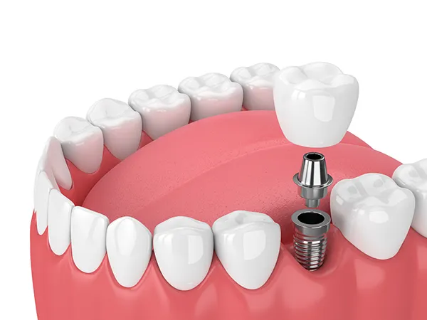 A dental implant and its components (screw, abutment, and crown) being placed into the jaw