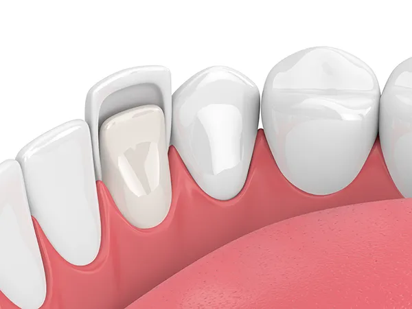 A thin porcelain veneer is applied to a tooth