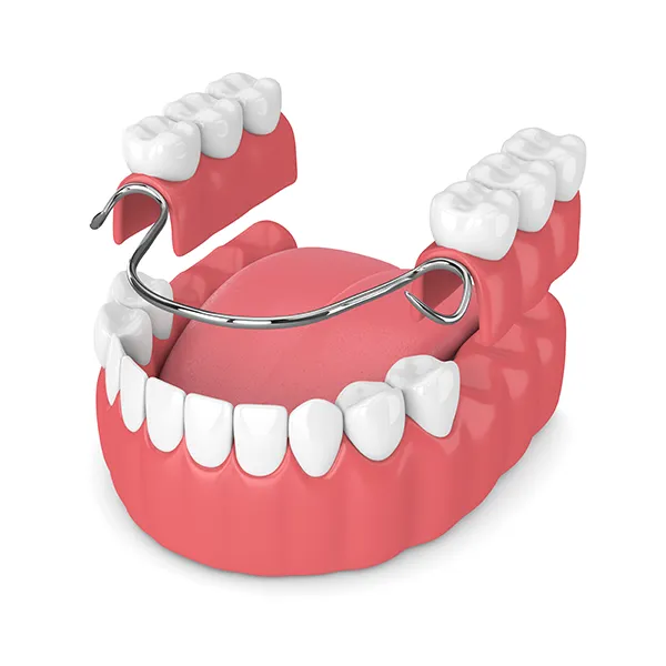 3D rendering of partial dentures being placed on a lower jaw with missing back teeth.