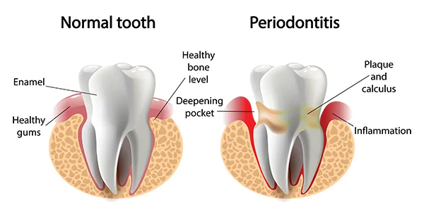 Side by side drawings comparing a healthy tooth with another tooth suffering from periodontal disease at Lakeview Dental Center 