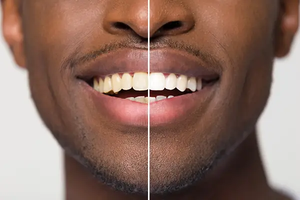 Close up comparison of before and after teeth whitening treatment on a smile.