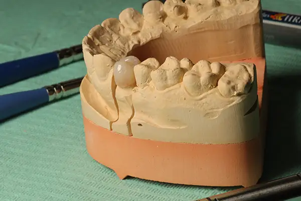Dental model showing preparation for a crown placement, with tools in the background.